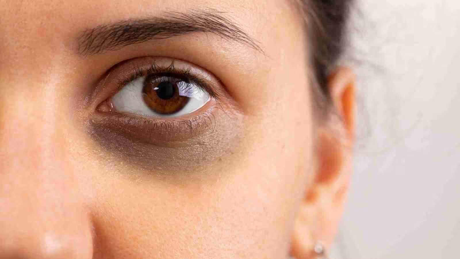 आंखों के नीचे काले घेरे से परेशान? अपनाएं ये आसान घरेलू उपाय